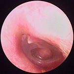 好酸球性中耳炎　鼓膜の状況