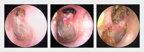 真珠腫性中耳炎　鼓膜の状況